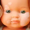 Doll with Vitiligo